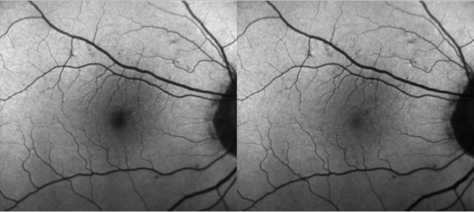 fundus autofluopresence_image1.png