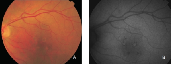 fundus autofluopresence_image10.png