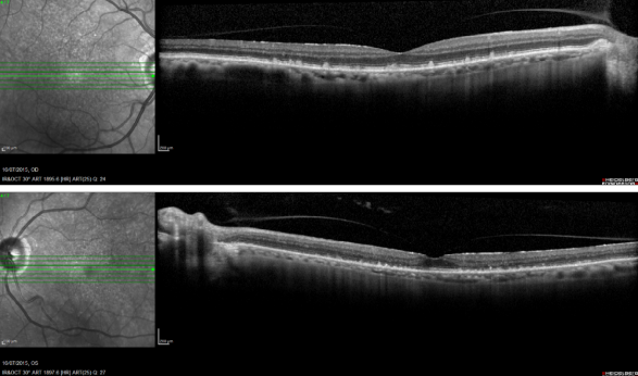 fundus autofluopresence_image11.png