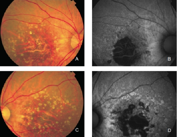 fundus autofluopresence_image12.png