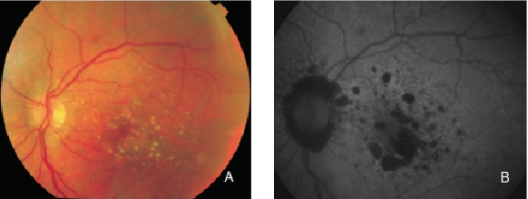 fundus autofluopresence_image13.png