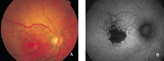 fundus autofluopresence_image14.png