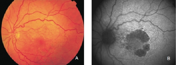 fundus autofluopresence_image15.png