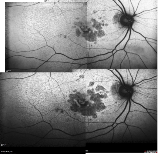 fundus autofluopresence_image16.png