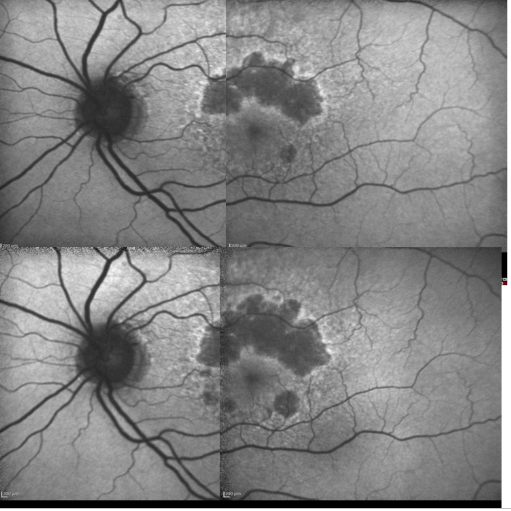 fundus autofluopresence_image17.png