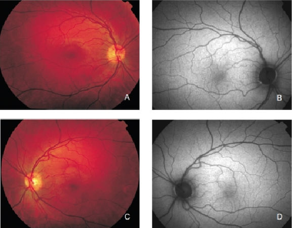 fundus autofluopresence_image2.png