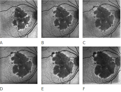 fundus autofluopresence_image20.png