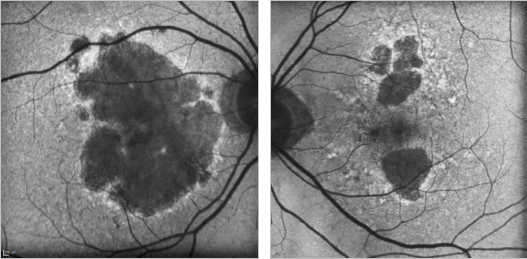 fundus autofluopresence_image21.png