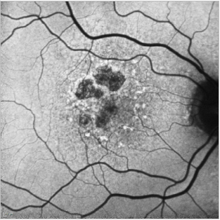 fundus autofluopresence_image22.png