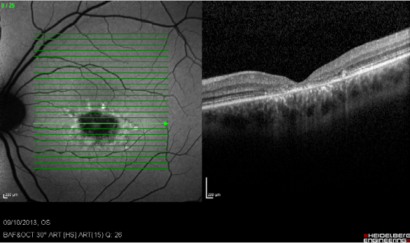 Modified Amsler Dubois Fundus Drawing Chart