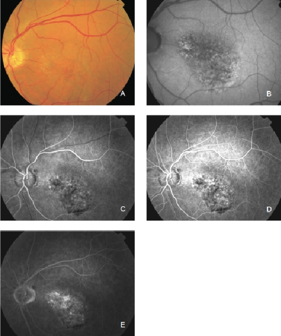 fundus autofluopresence_image24.png