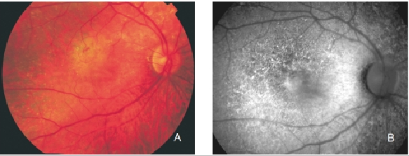 Modified Amsler Dubois Fundus Drawing Chart