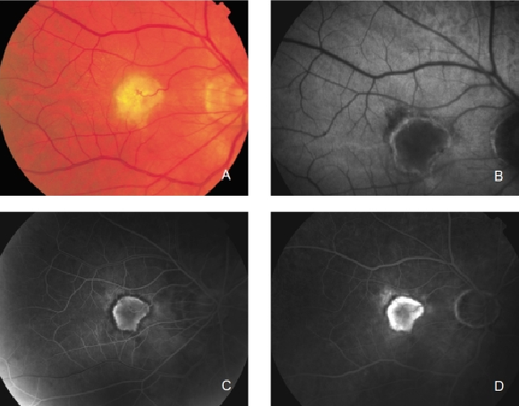 Modified Amsler Dubois Fundus Drawing Chart