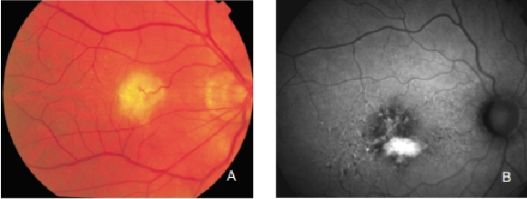 fundus autofluopresence_image28.png