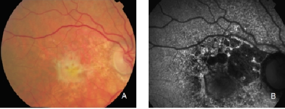 fundus autofluopresence_image29.png