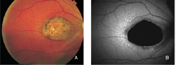 fundus autofluopresence_image3.png