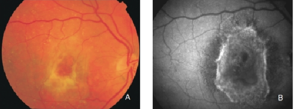 fundus autofluopresence_image30.png