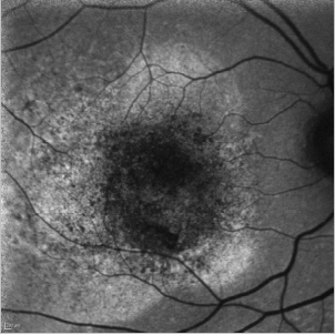 fundus autofluopresence_image33.png