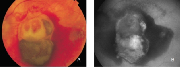 fundus autofluopresence_image4.png