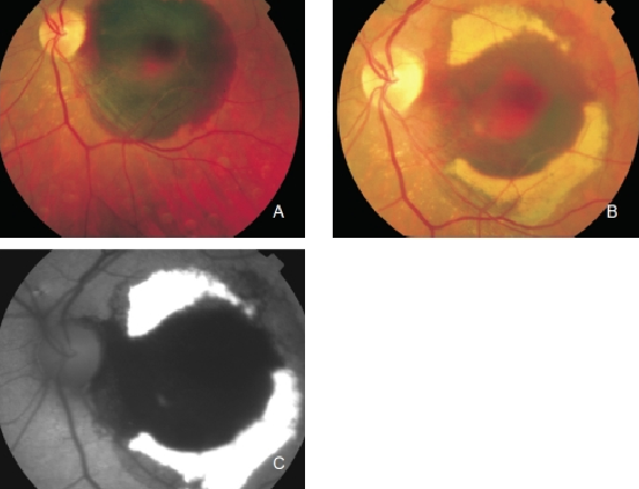 fundus autofluopresence_image5.png