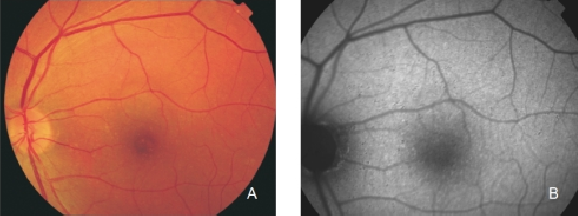 fundus autofluopresence_image6.png