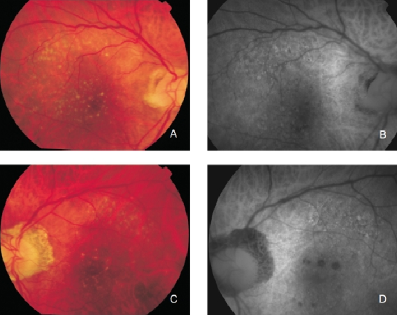 fundus autofluopresence_image7.png