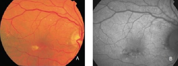 fundus autofluopresence_image8.png