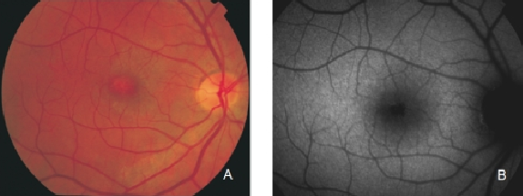 fundus autofluopresence_image9.png