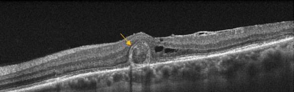 optical-coherence-tomography-age-related-macular-degeneration-image26.png