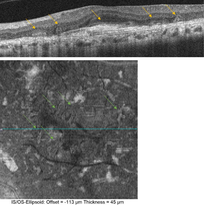 optical-coherence-tomography-age-related-macular-degeneration-image27.png