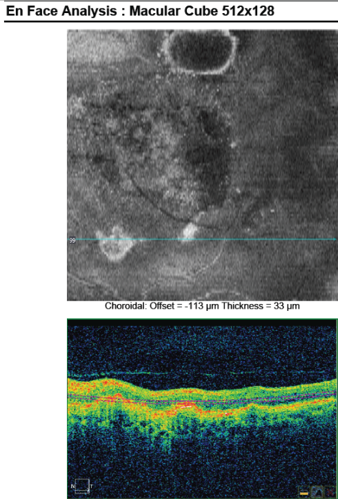 optical-coherence-tomography-age-related-macular-degeneration-image28.png