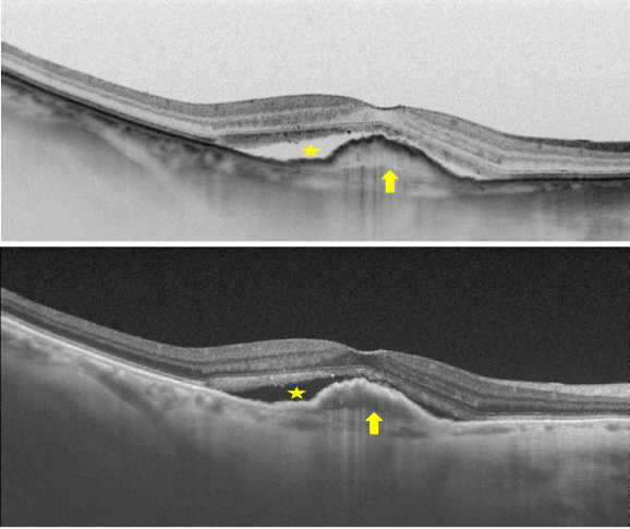 optical-coherence-tomography-age-related-macular-degeneration-image32.png