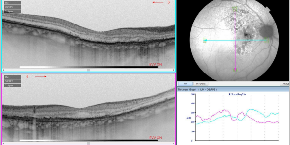 optical-coherence-tomography-age-related-macular-degeneration-image34.png