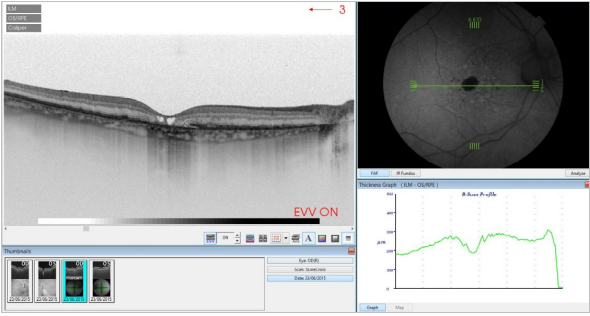 optical-coherence-tomography-age-related-macular-degeneration-image35.png