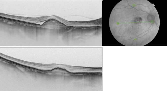 optical-coherence-tomography-age-related-macular-degeneration-image37.png