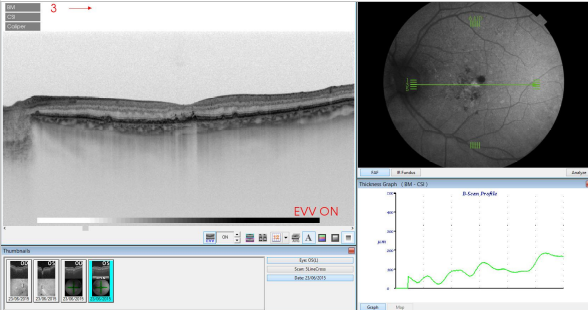 optical-coherence-tomography-age-related-macular-degeneration-image38.png