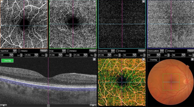 optical-coherence-tomography-age-related-macular-degeneration-image40.png