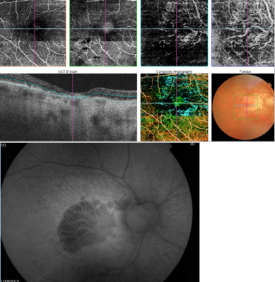 optical-coherence-tomography-age-related-macular-degeneration-image42.png