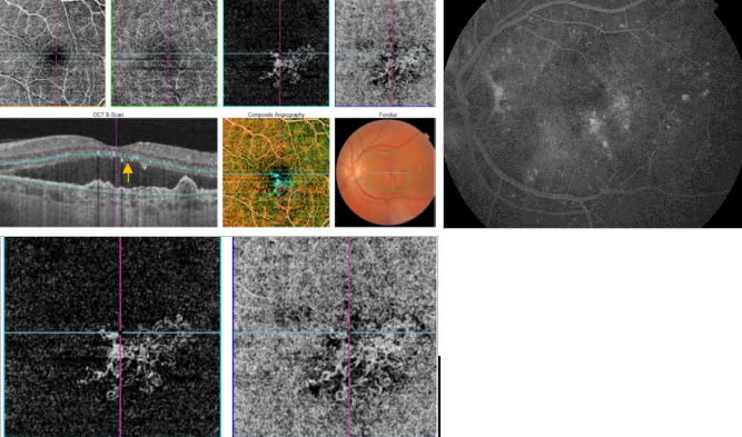 optical-coherence-tomography-age-related-macular-degeneration-image43.png