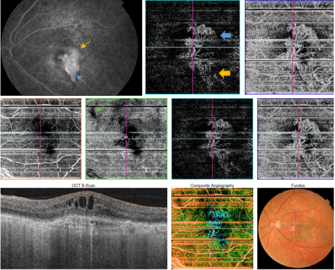optical-coherence-tomography-age-related-macular-degeneration-image49.png