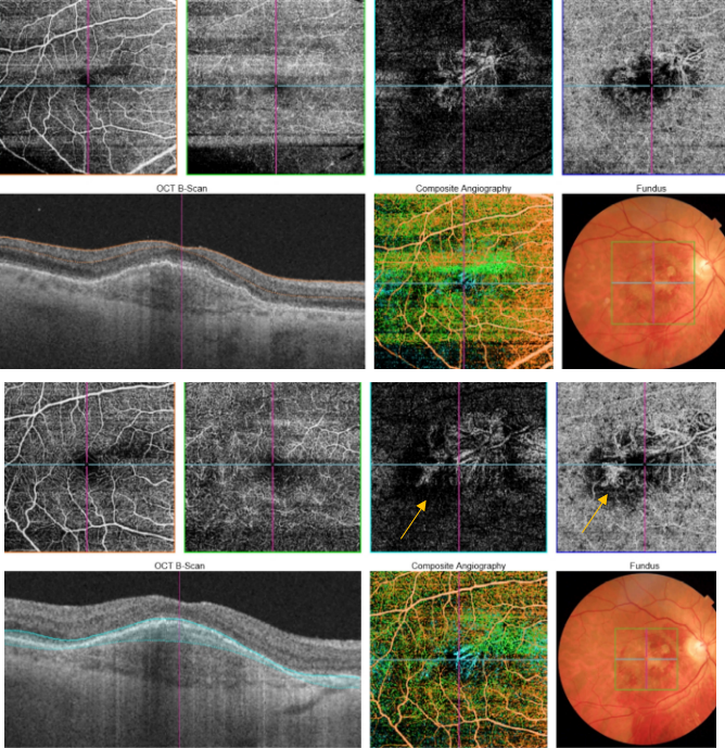 optical-coherence-tomography-age-related-macular-degeneration-image50.png
