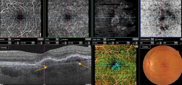 optical-coherence-tomography-age-related-macular-degeneration-image52.png